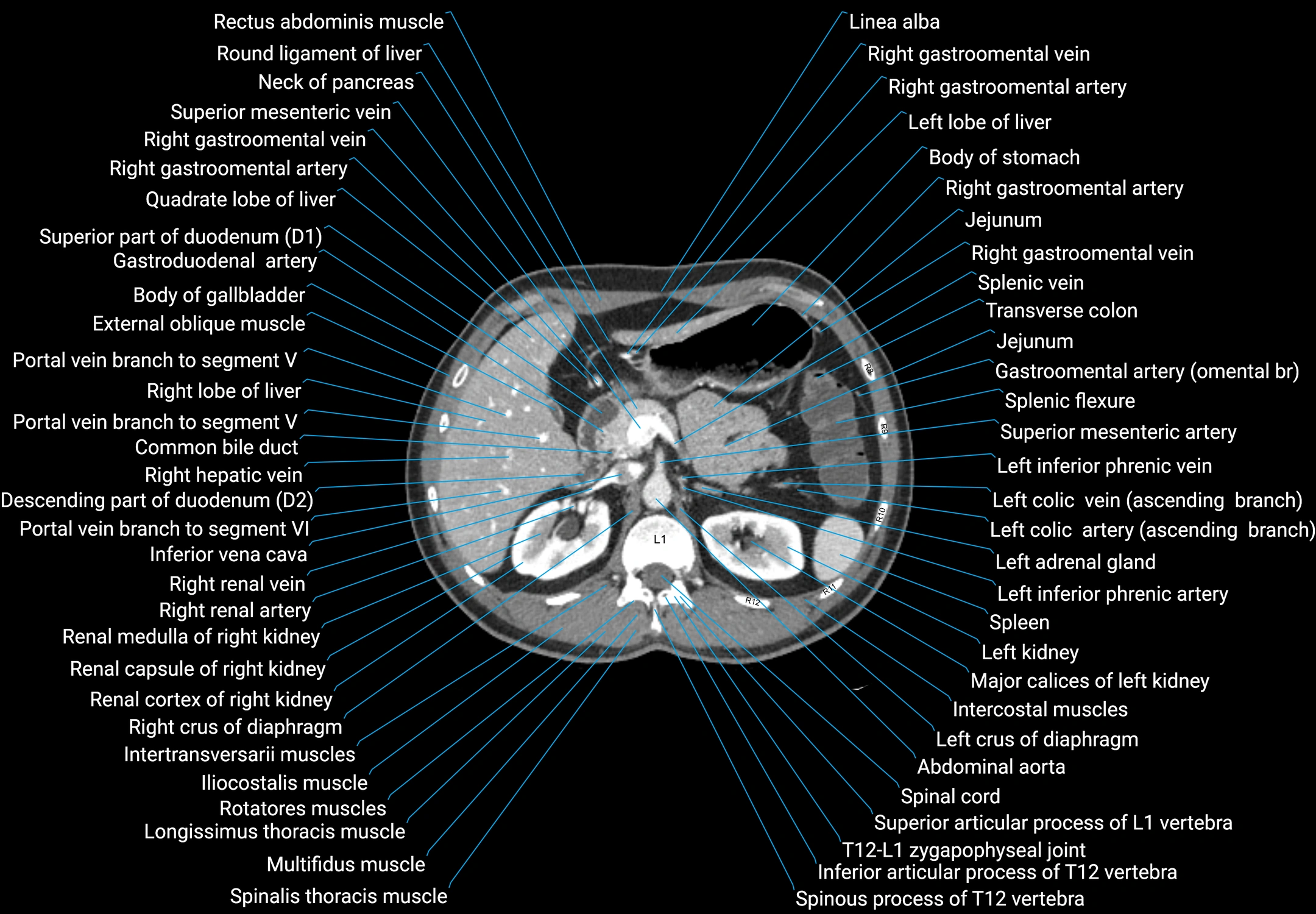 CT male pelvis axial cross sectional anatomy labelled radiology image -00052.webp